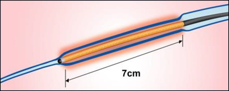 Процедура посегментной РЧА _ посегментная абл _ 1.png