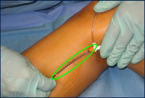 Процедура посегментной РЧА _ проведение процедуры _ 13.png