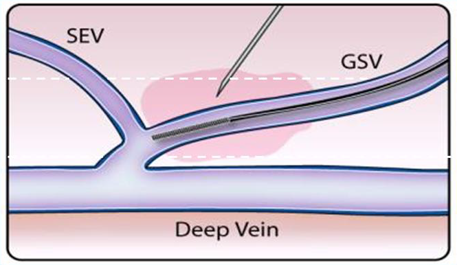 Процедура посегментной РЧА _ проведение процедуры _ 6.png