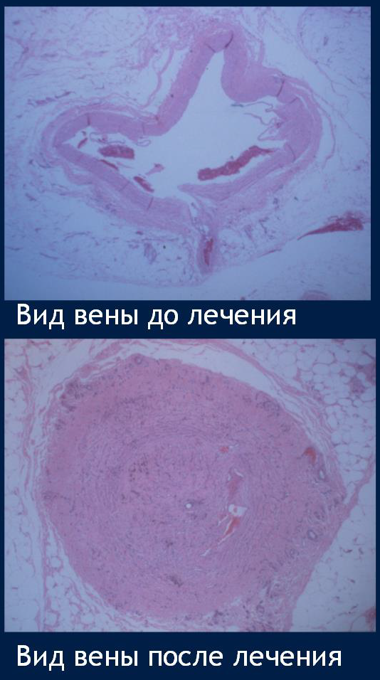 Процедура посегментной РЧА _ метод воздействия.png