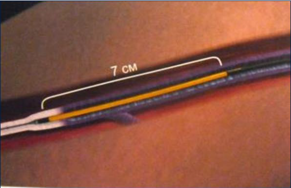 Процедура посегментной РЧА _ метод воздействия under.png