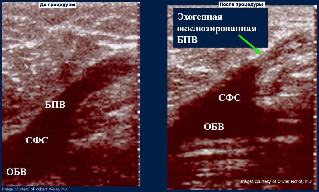 Процедура посегментной РЧА _ проведение процедуры _ рекомендации после.png