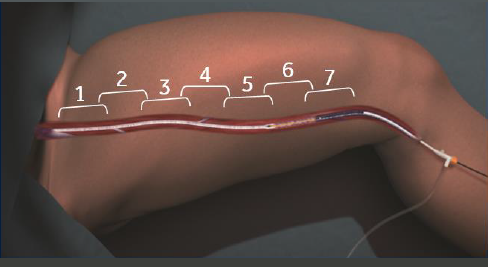 Процедура посегментной РЧА _ проведение процедуры _ 11 _ этап 4.png