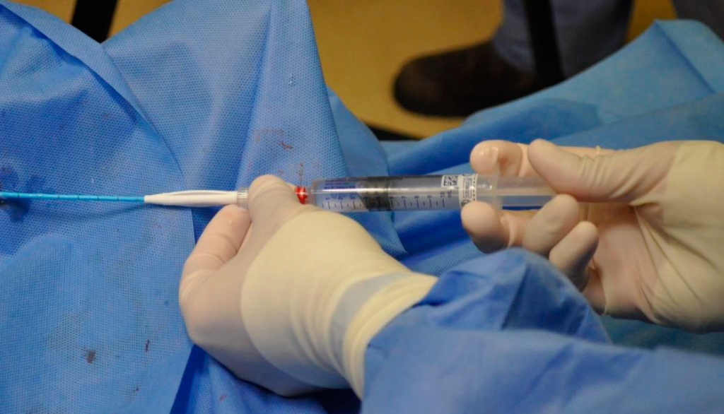 VenaSeal Procedure.png VenaSeal Procedure.png