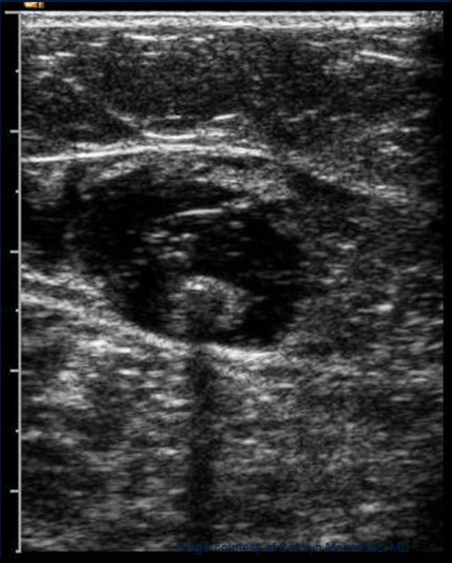 Процедура посегментной РЧА _ проведение процедуры _ 5.png