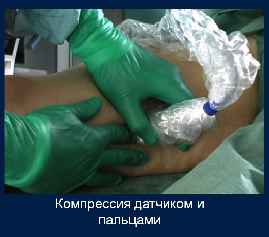 Процедура посегментной РЧА _ проведение процедуры _ 12.png