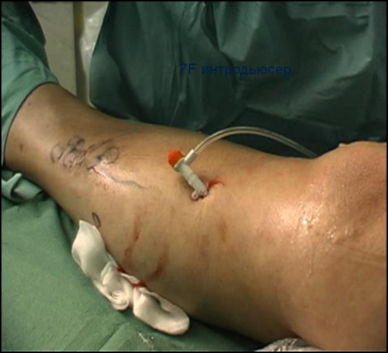 Процедура посегментной РЧА _ проведение процедуры _ 2.png