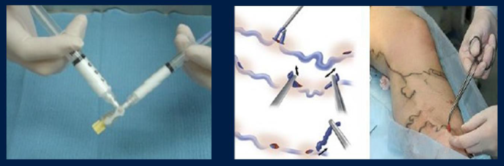 Процедура посегментной РЧА _ проведение процедуры _ притоки.png