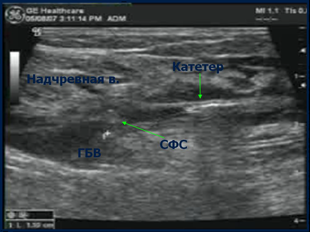 Процедура посегментной РЧА _ проведение процедуры _ 3.png